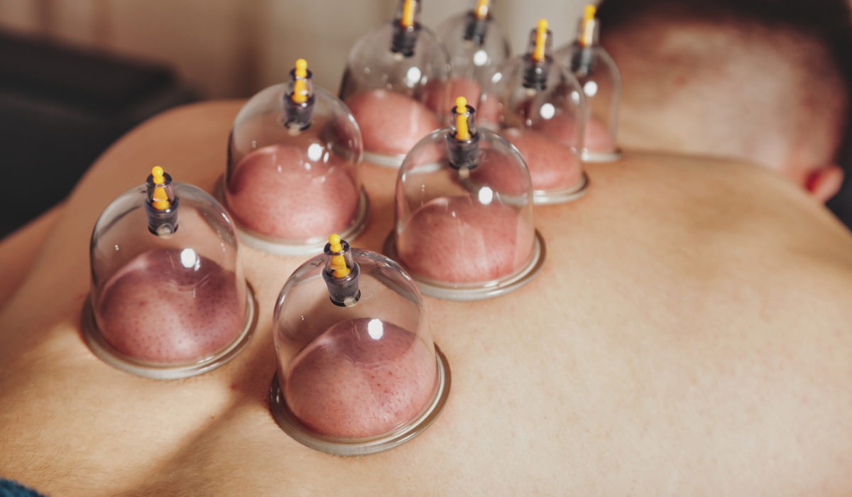 Close-up of cupping therapy cups applied to a patient's back during a professional session in a modern Pottsville clinic